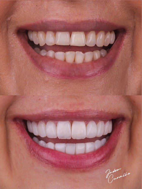 Resultado de facetas dentais