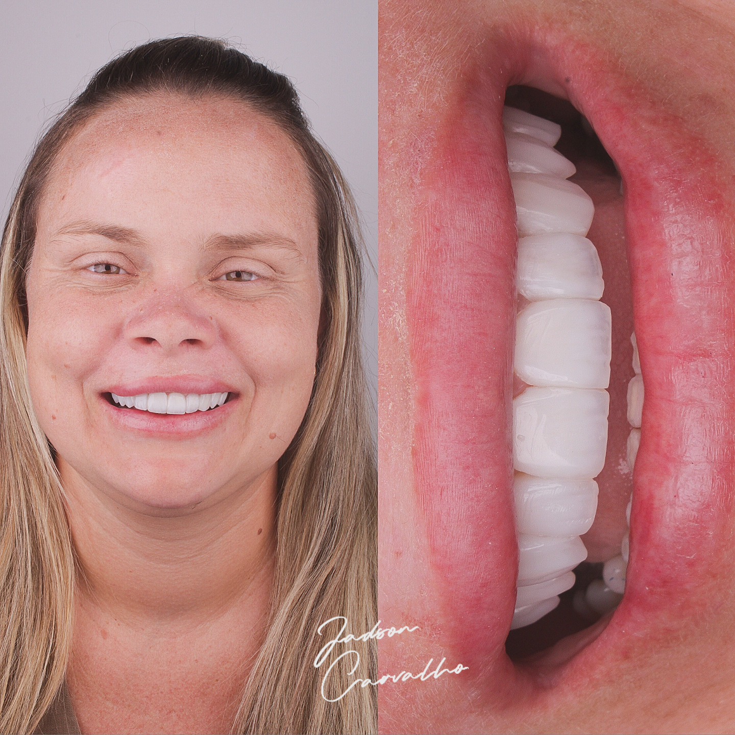 Resultado de facetas em resina composta