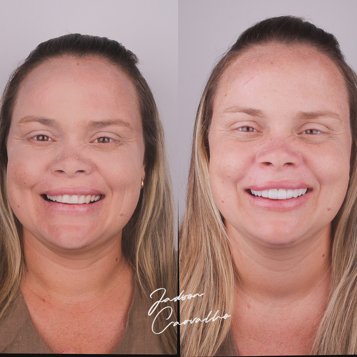 Resultado de harmonização do sorriso com facetas